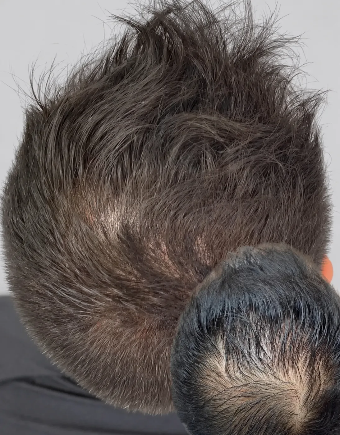 Density scalp micropigmentation on a thinning crown, shown before and after