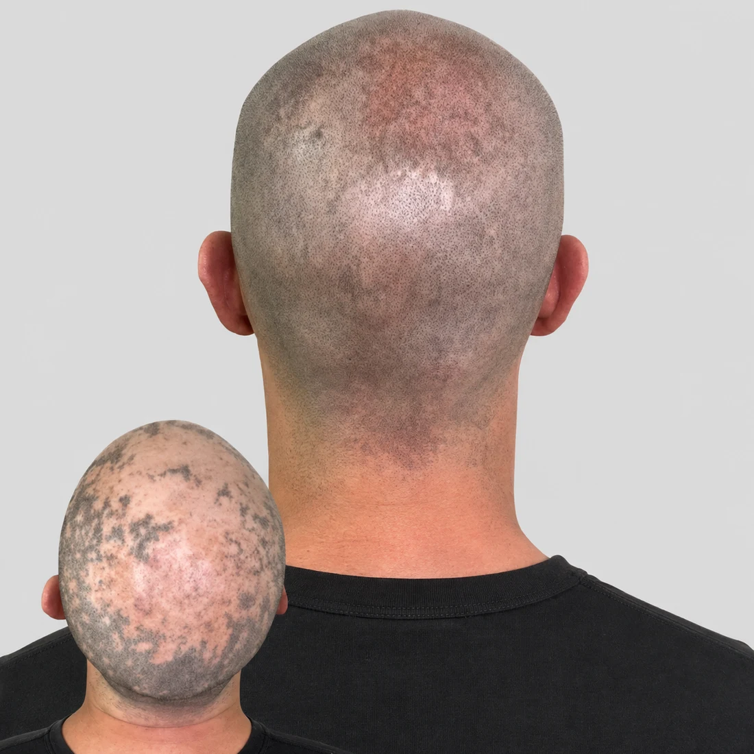 Alopecia SMP at San Diego SMP